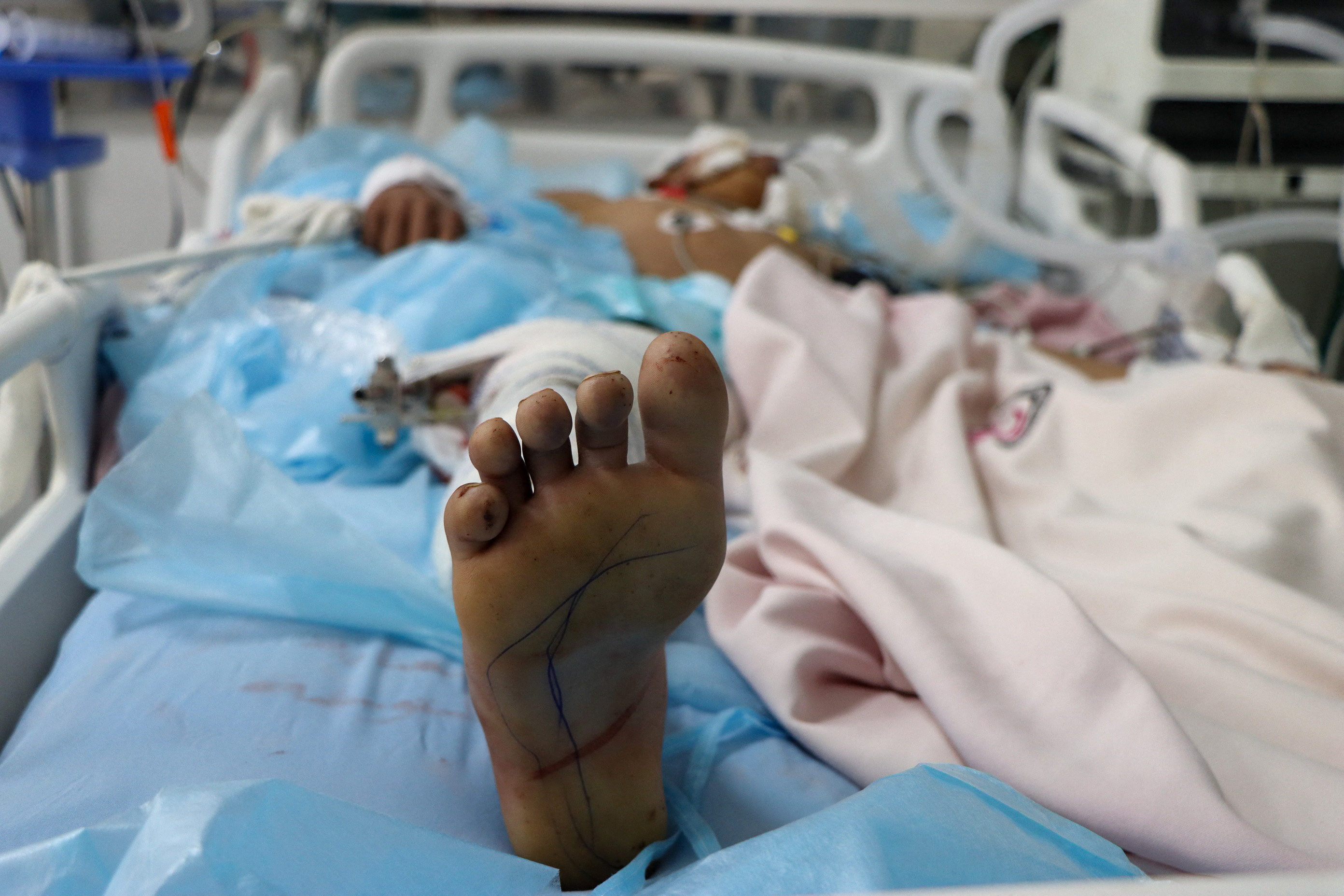 A boy lies on a bed at a hospital where he is being treated for injuries he sustained by a US air strike in Saada, Yemen March 25, 2025. REUTERS/Naif Rahma