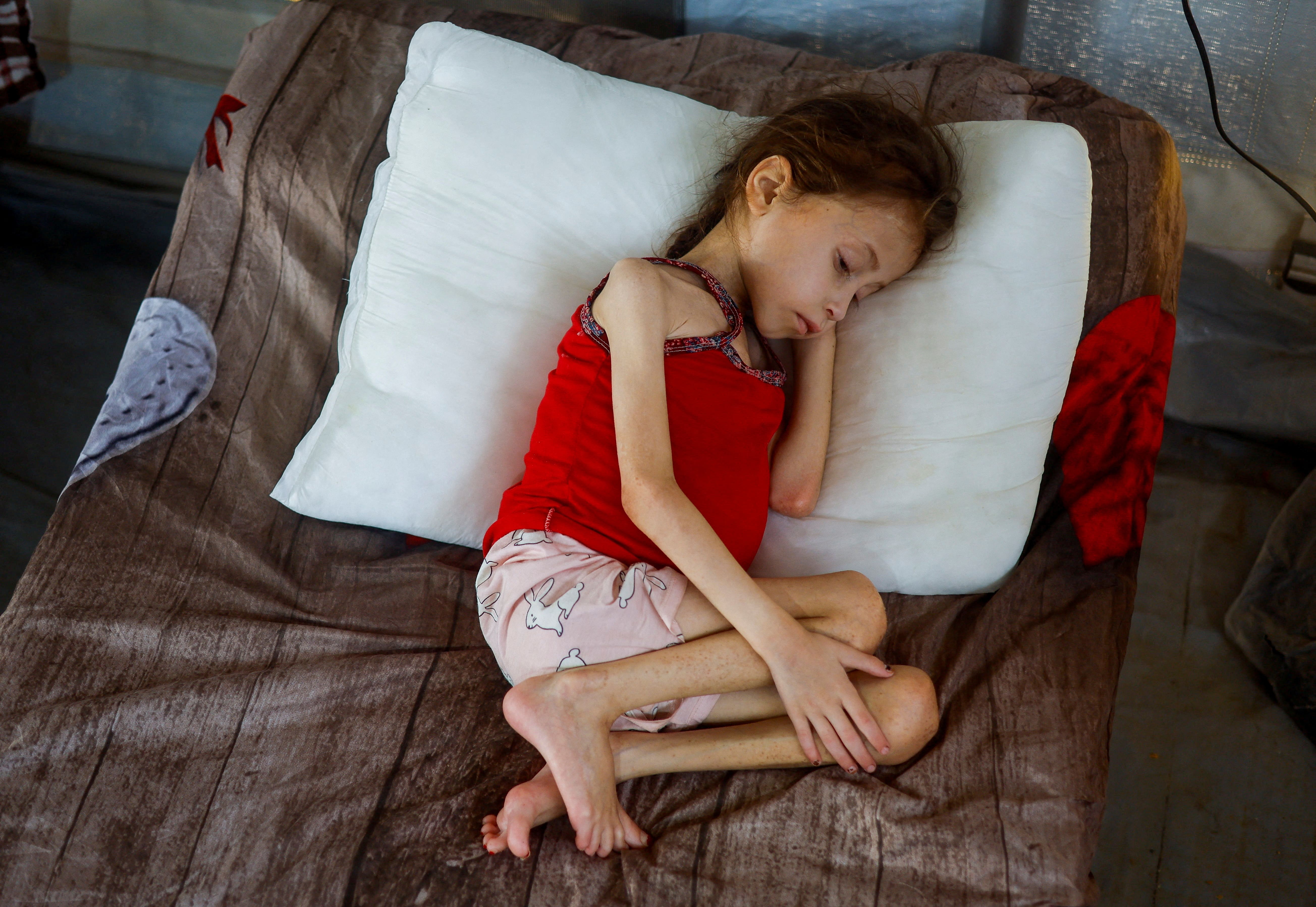 Jana Ayad, a malnourished Palestinian girl, rests on a bed as she receives treatment at the International Medical Corps field hospital, amid the Israel-Hamas conflict, in Deir Al-Balah in the southern Gaza Strip, June 22, 2024. REUTERS/