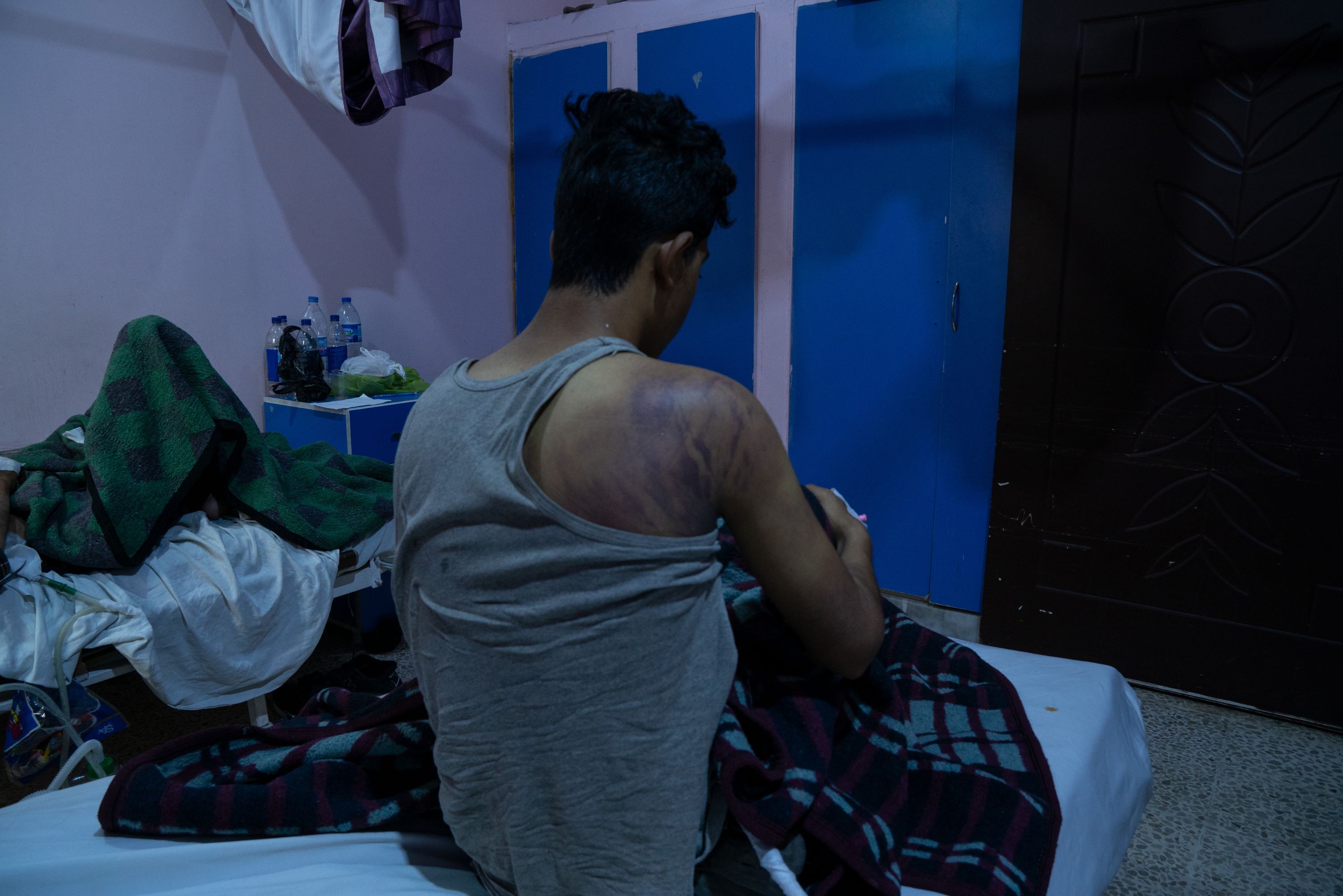 Traces des violences dont Youssef Muhammad al-Harj a été victime aux mains de gendarmes turcs, alors que lui et ses compagnons tentaient de franchir la frontière (MEE/Ahmad Fallaha)