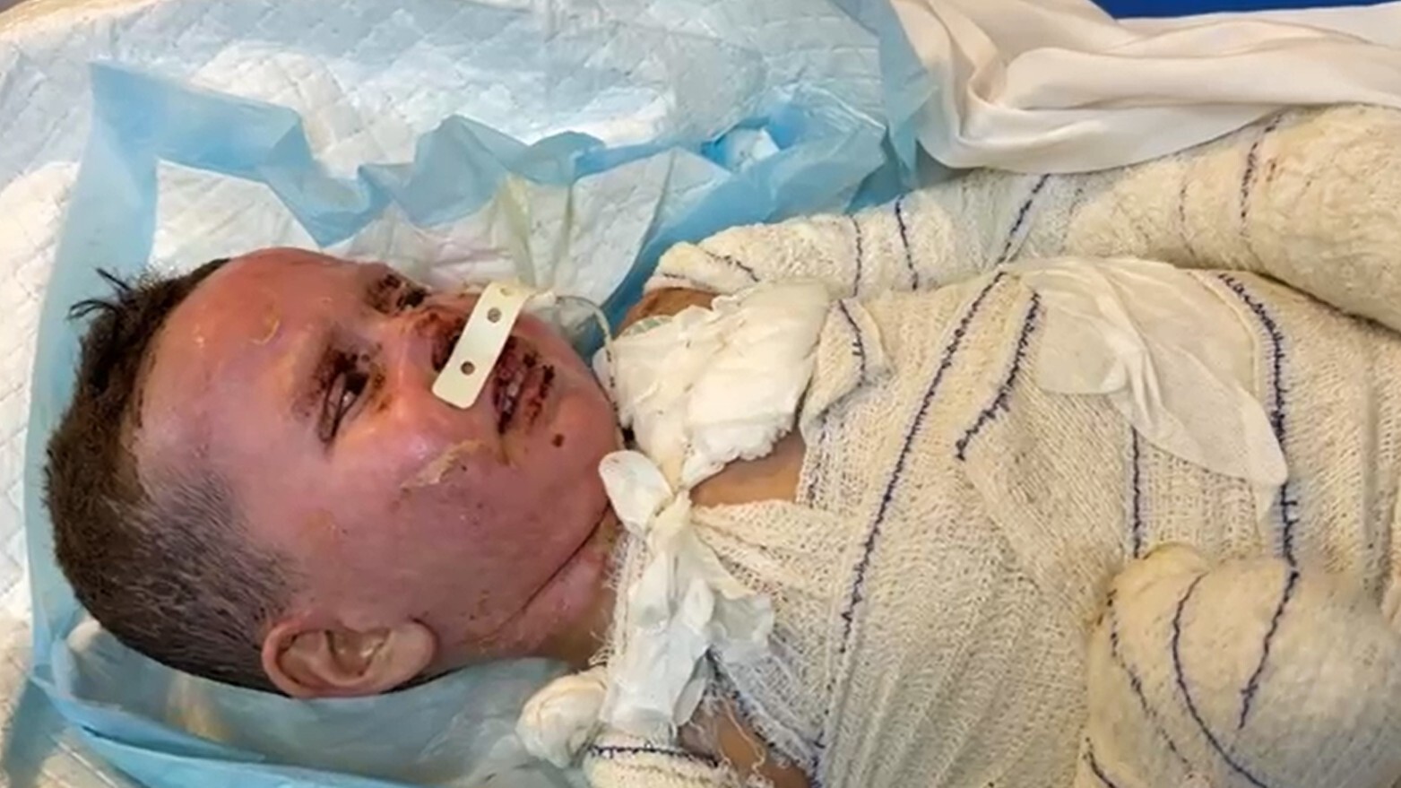 Haitim, 3, is treated in Nasser Hospital in May 2025 (Dr Victoria Rose)