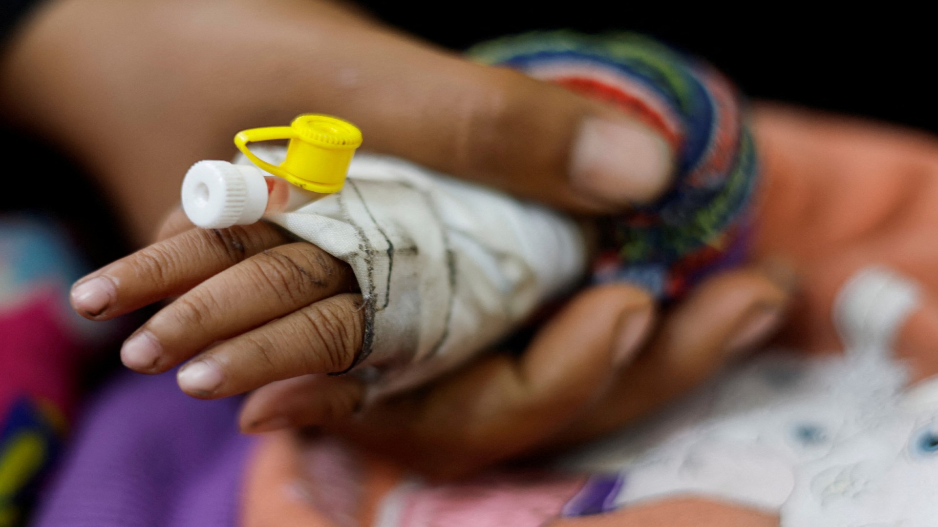 Palestinian child suffering from malnutrition