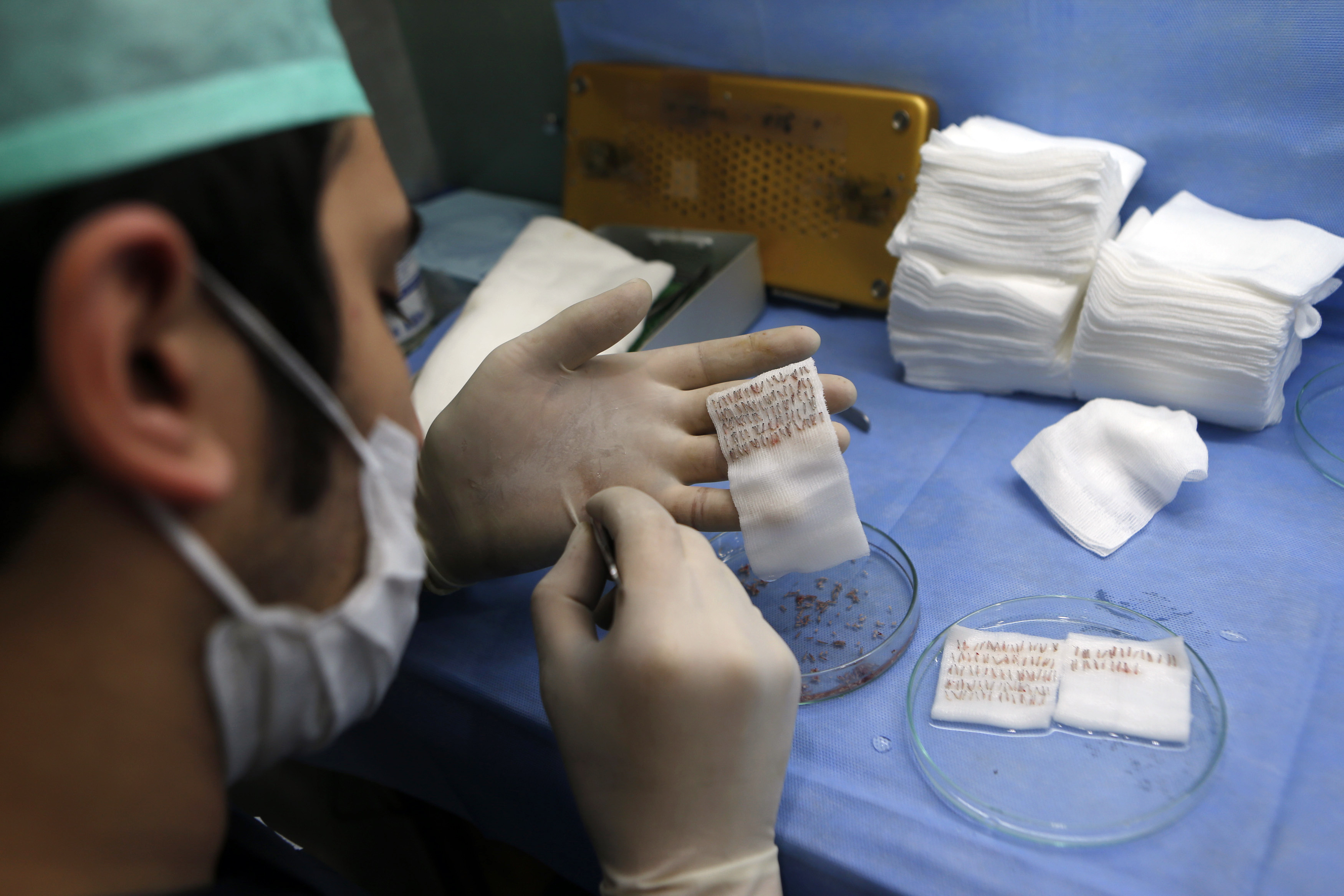 hair transplant istanbul 