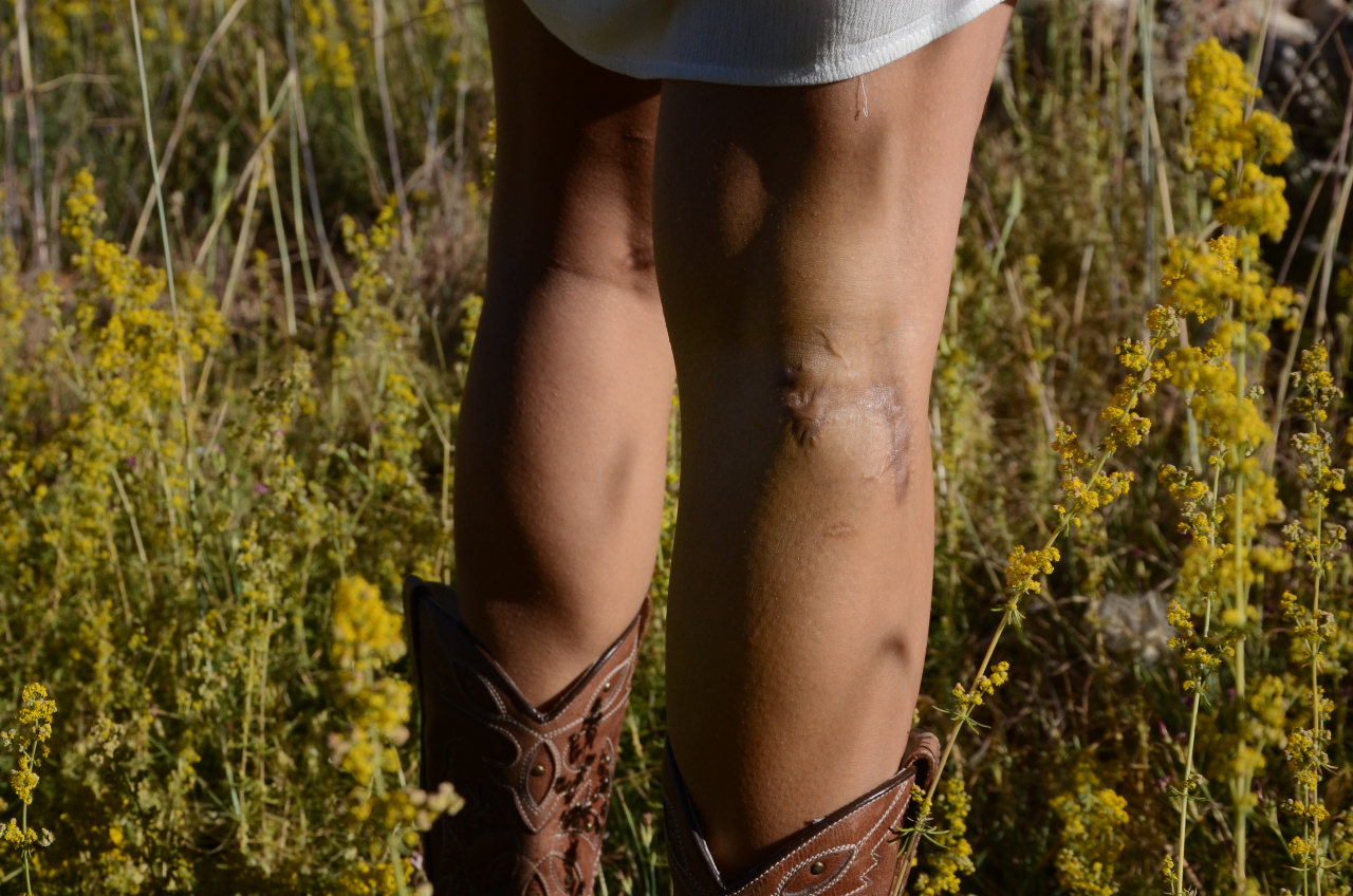 Pieces of glass and stone cut though Marie-Therese's flesh and severed the artery behind her right knee (MEE) 