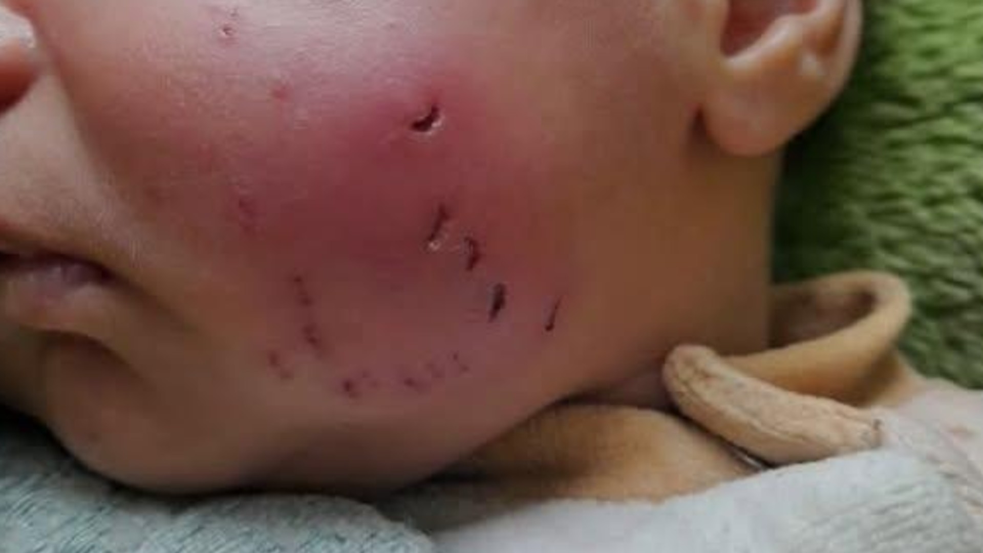 Marks of a rat bite left on the cheek of one-month-old in Gaza (X)