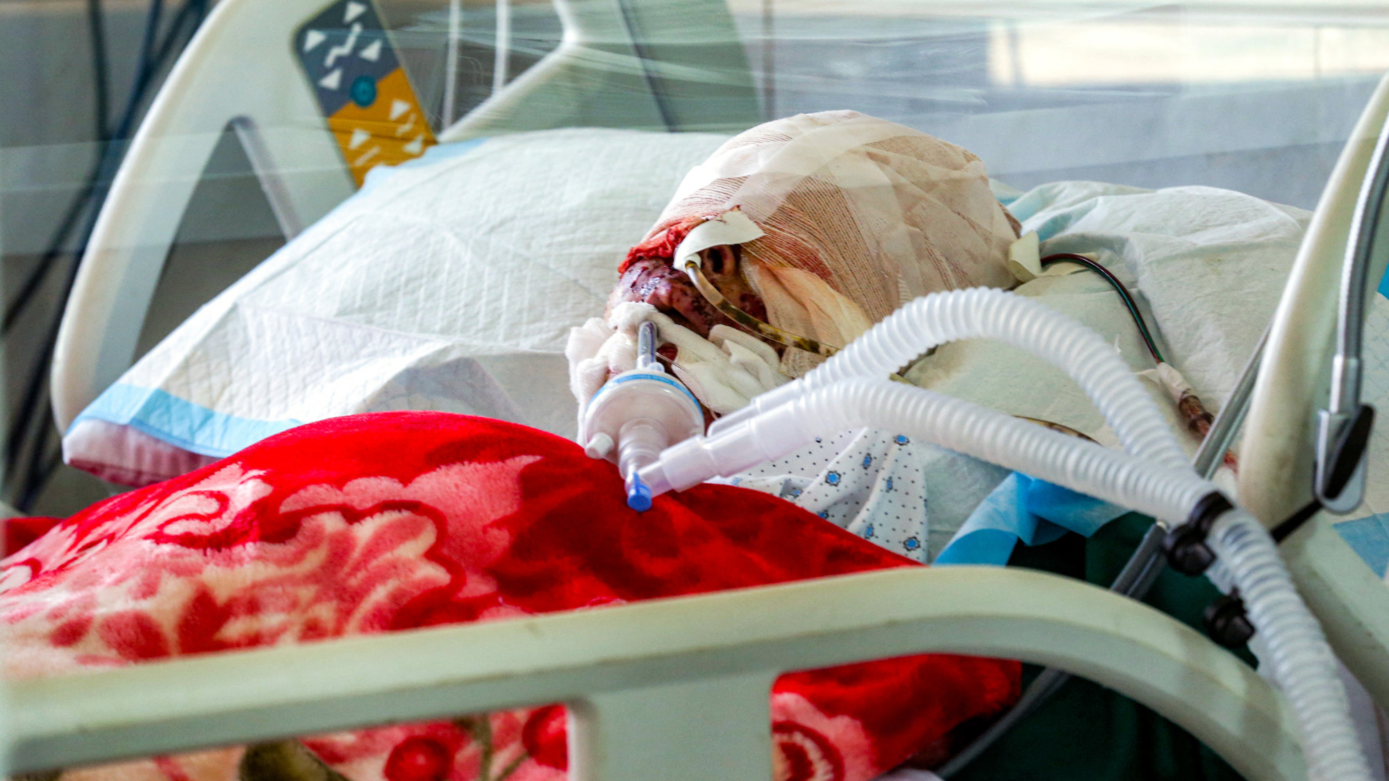 Aseel Sharara, a child who was severely wounded by an Israeli drone strike the previous day in Bint Jbeil, south Lebanon, lies intubated in the ICU at a hospital in Tebnine, 22 September 2025 (AFP)