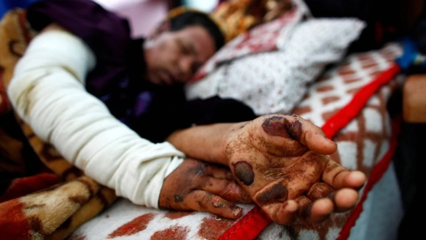 A patient at al-Shifa Hospital in Gaza in January 2009 with wounds indicating white phosphorus exposure amid Israel's war on the enclave (Jerry Lampen/Reuters)