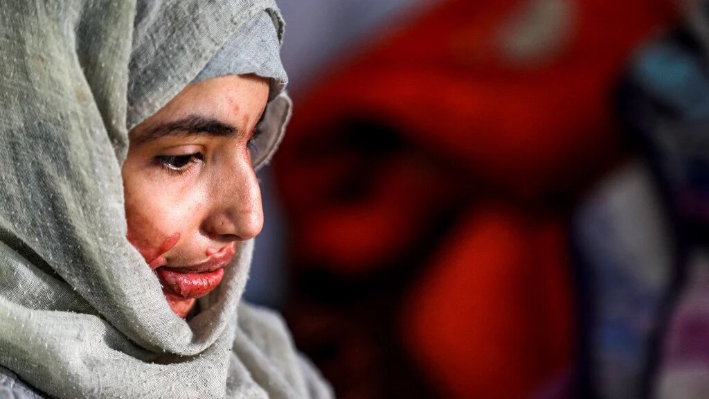 Al-Anoud a presque perdu l’œil gauche et son visage et corps ont été atteints de profondes brûlures (AFP)