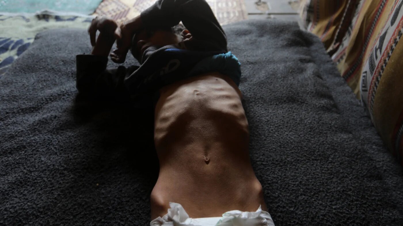 Ten-year-old Mohammed Ahmed Massoud al-Sousi, who suffers from malnutrition due to Israeli restrictions on aid entering Gaza, sits inside a tent in Gaza City on 6 May 2026 (Bilal Osama/IMAGO/APAimages via Reuters)