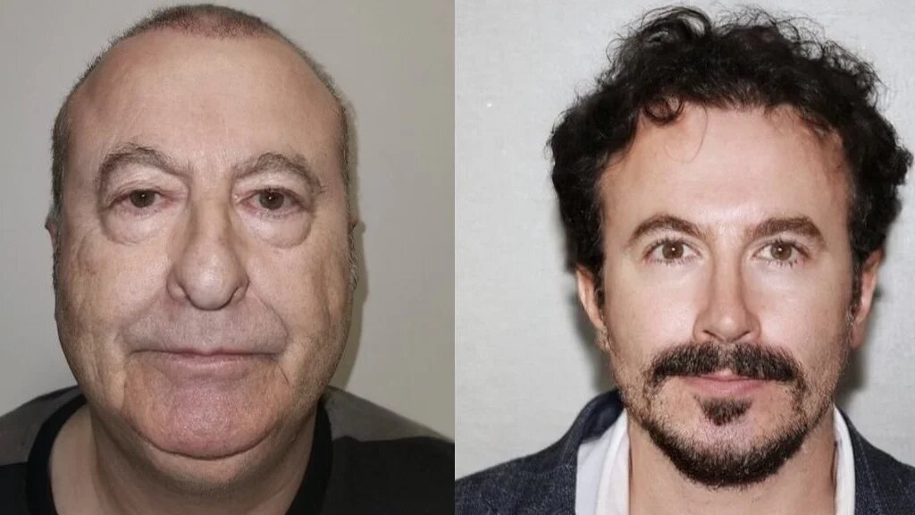 An image of 'Michael,' that the apparent American tourist before and after surgery (Instagram)