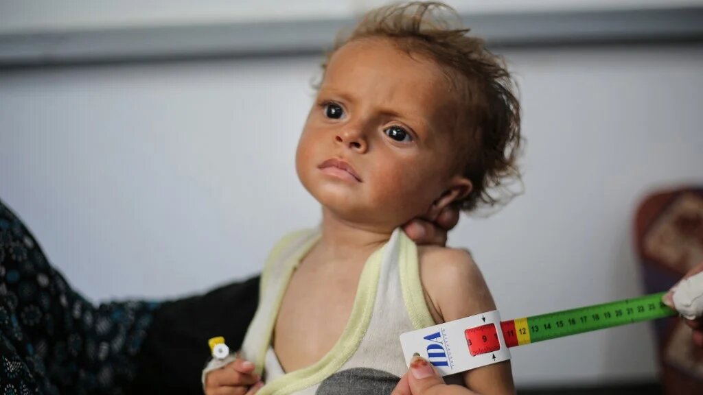 A malnourished Palestinian child is examined at a hospital in the Nuseirat refugee camp, in the central Gaza Strip, on 30 June 2025 (Eyad Baba/AFP)