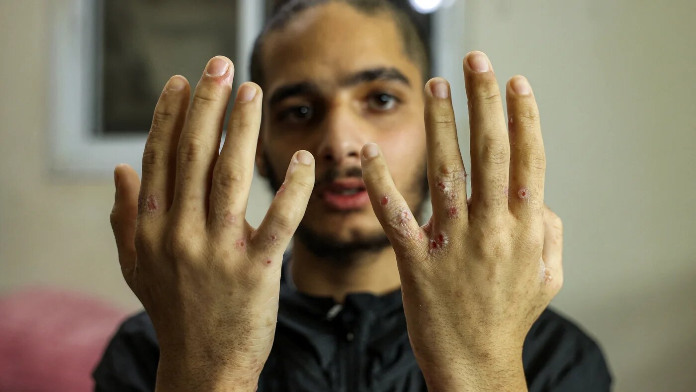 An 18-year-old Palestinian suffering from scabies shows the affected parts of his body a day after his release from an Israeli prison on 31 January 2025 as part of the Gaza ceasefire and prisoner exchange deal between Israel and Palestinian factions (AFP)