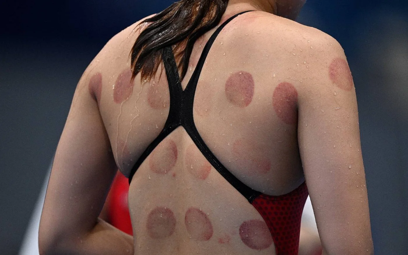 Les athlètes utilisent les ventouses dans le but de guérir plus rapidement (AFP/Oli Scarff)