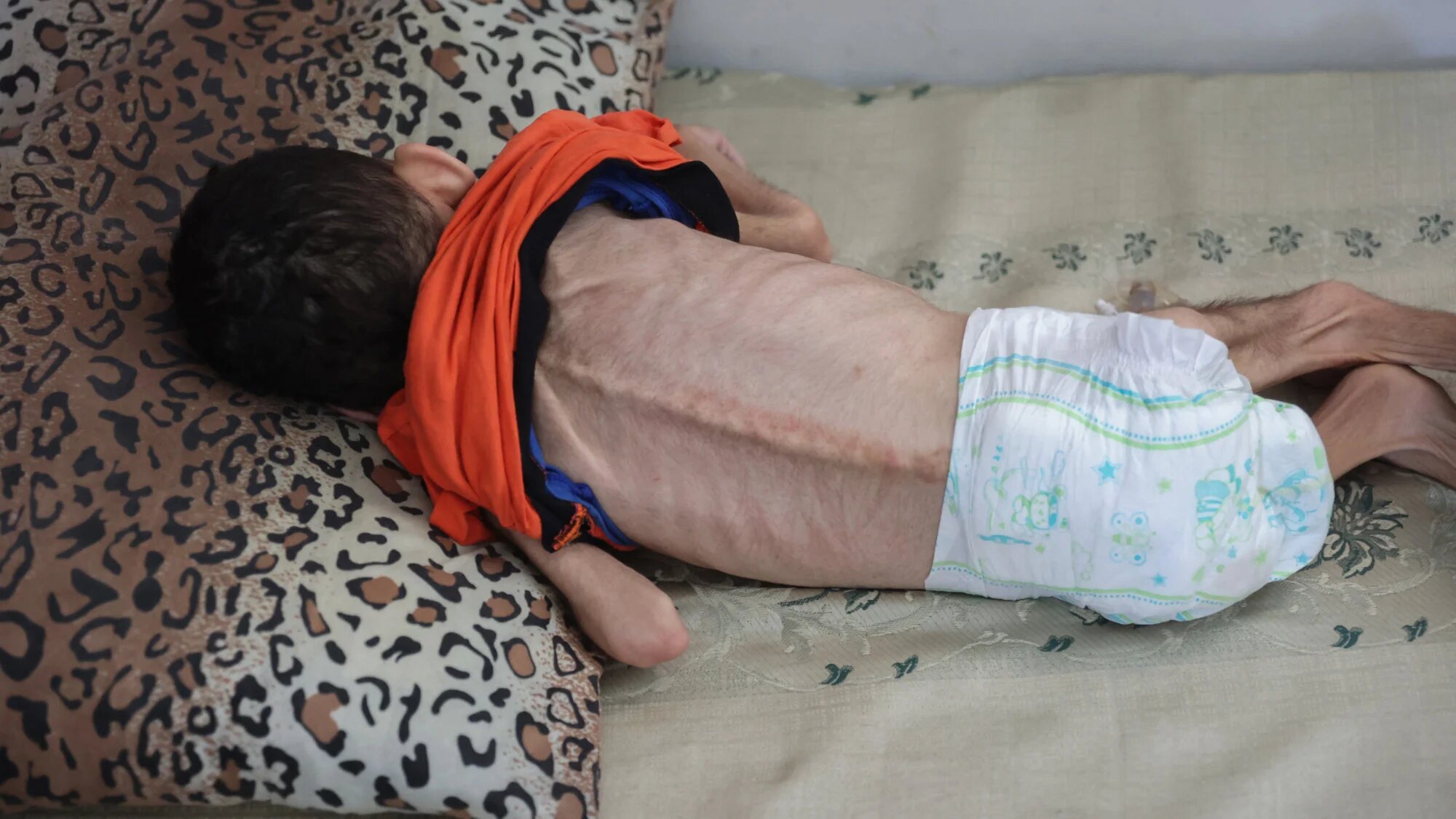 Palestinian four-year-old with cerebral palsy who also suffers from malnutrition rests at a shelter at the UN-run Salaheddin school in the Rimal neighbourhood of central Gaza City on 10 June 2024 (AFP/Omar al-Qattaa)