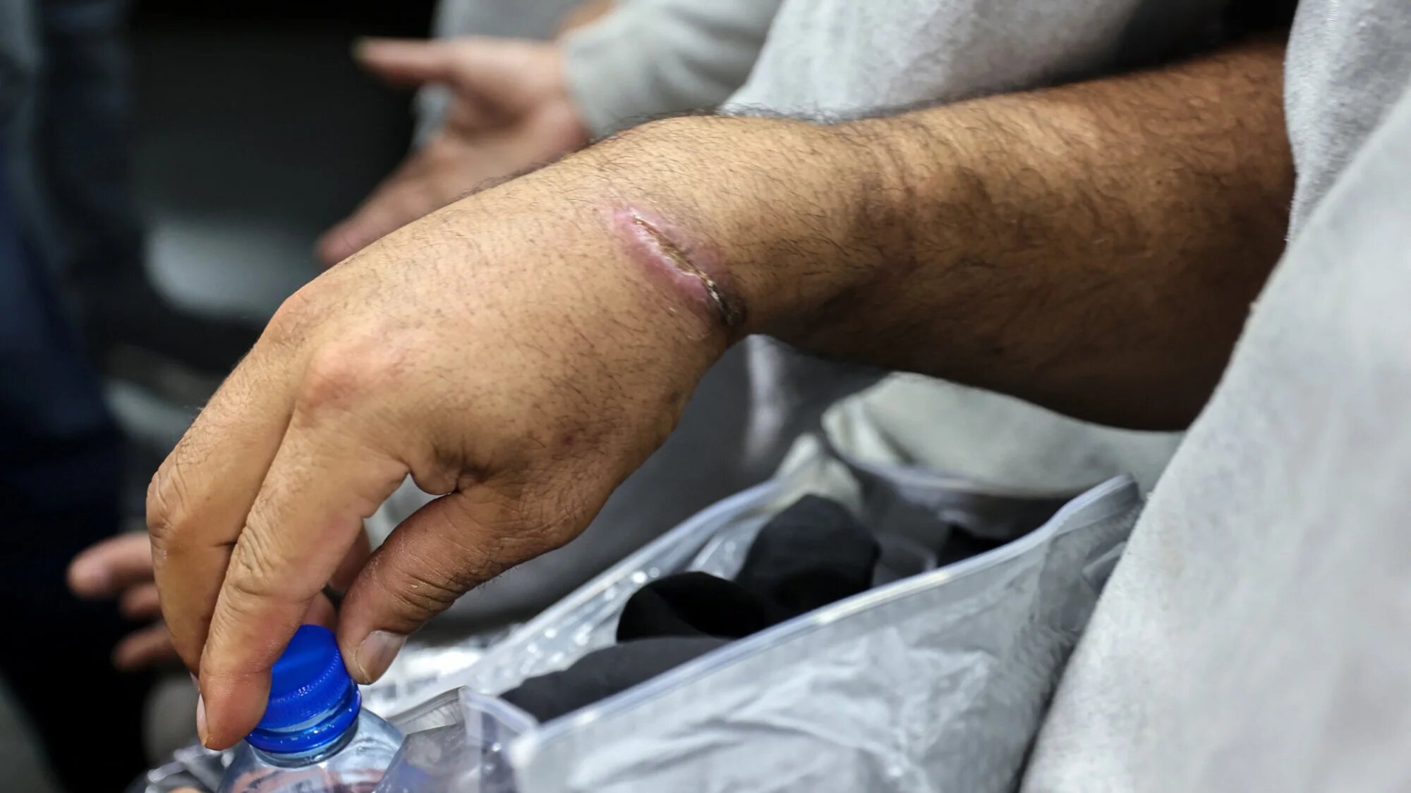 A scar on the wrist of a Palestinian released from Israeli prisons at the Al-Aqsa Martyrs hospital in Deir el-Balah, central Gaza, on 10 April 2025 (AFP/Eyad Baba)