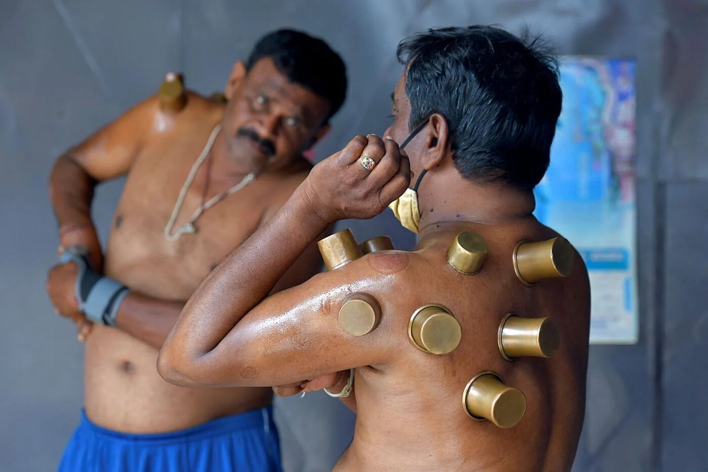 Les ventouses sont une forme de médecine alternative populaire en Chine, en Asie du Sud et au Moyen-Orient (AFP)