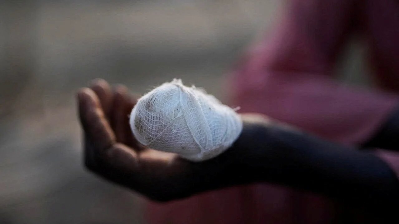A child shows an injured hand at a camp for displaced people who fled from el-Fashir to Tawila, North Darfur, Sudan, 27 October 2025 (Reuters/Mohammed Jamal)