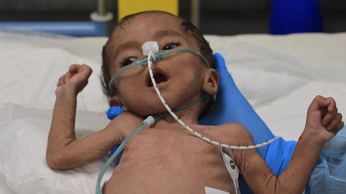 A Palestinian child suffering from malnutrition is treated at the Nasser hospital in Khan Yunis, Gaza, on 10 July 2024 (AFP)